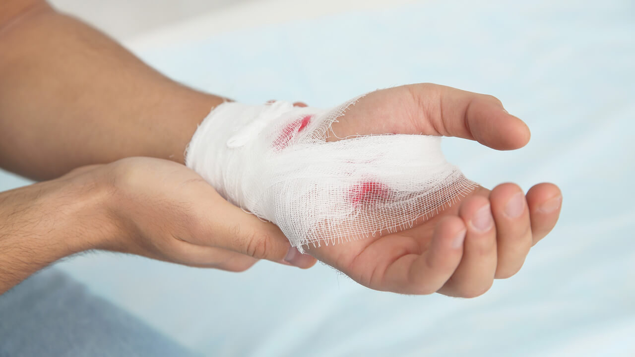Compensación por quemaduras en accidente laboral en Alabama: qué hacer